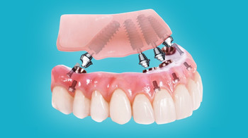 «Все на 4 имплантах» – популярная методика протезирования зубов